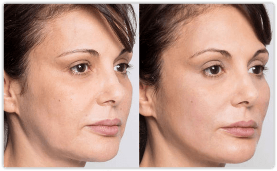 Before and After 2