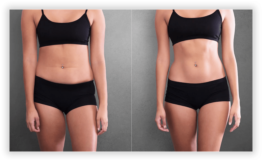 Body Contouring 1