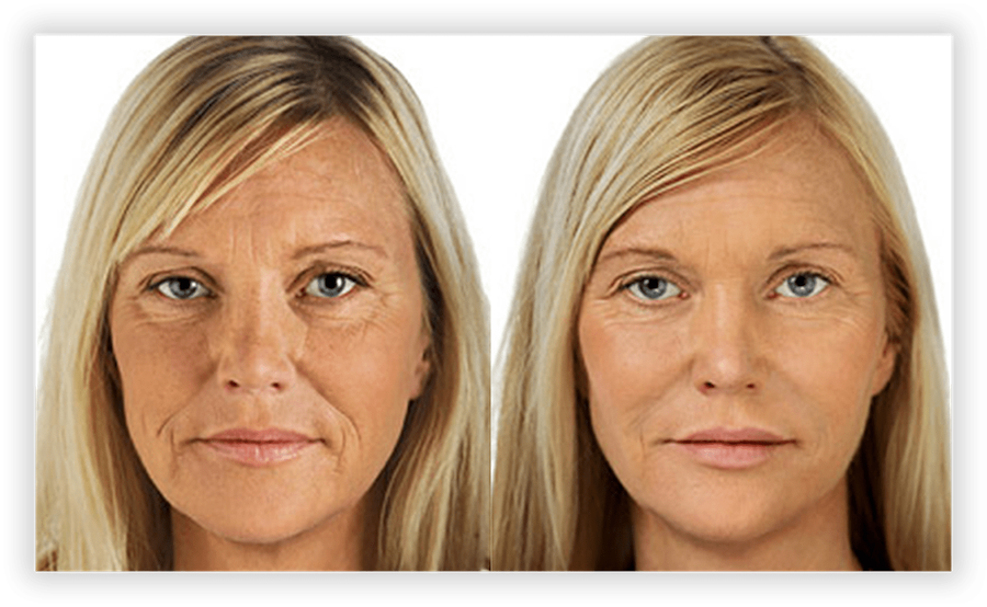 Botox 1