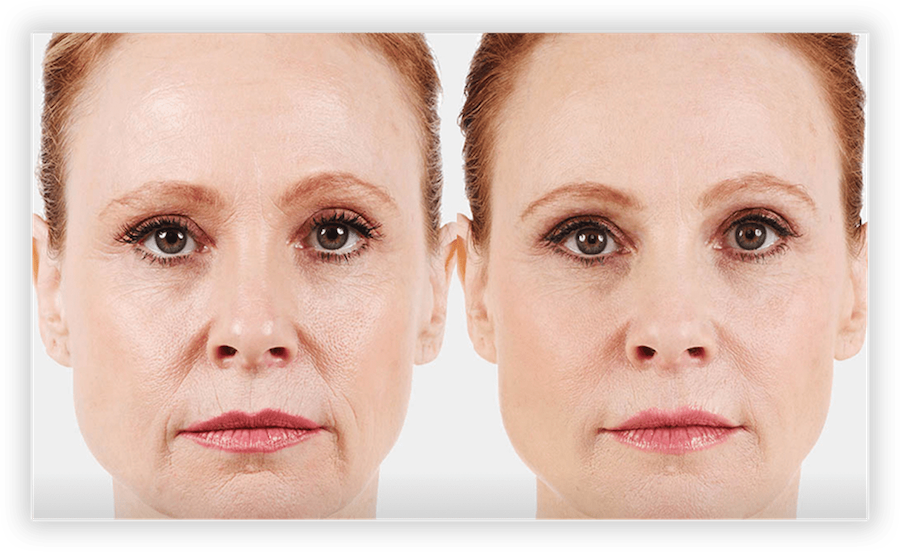 Dermal Fillers 2