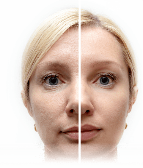 Dermal Filler Candidates Toronto