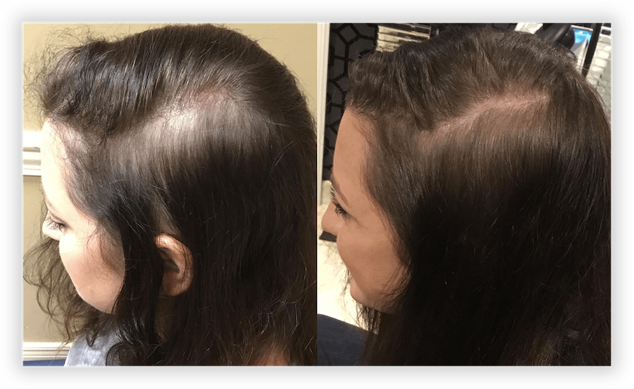 Hair Restoration 2