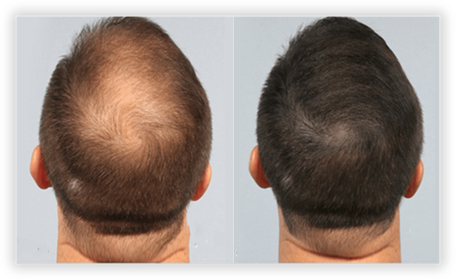 Hair Restoration 1
