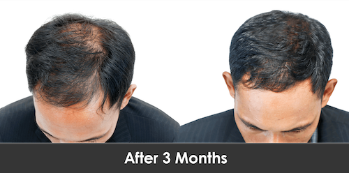 Hair Loss Results - Mississauga
