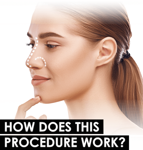 How non-surgical nose jobs work