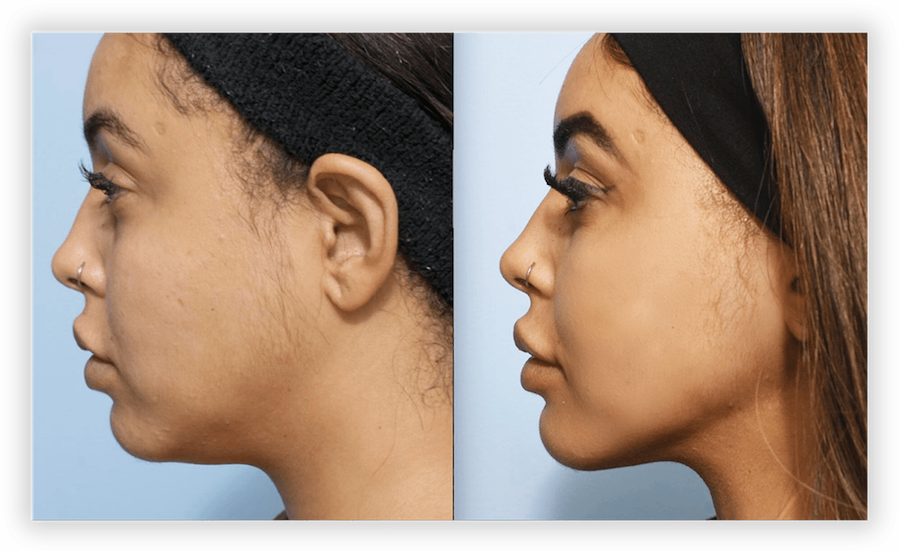 Liquid Lipo 2