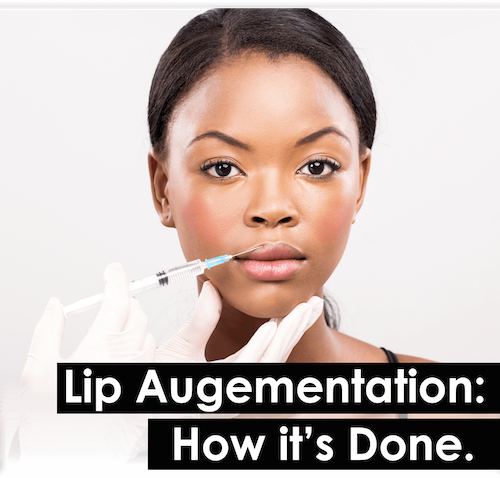 Lip Augmentation