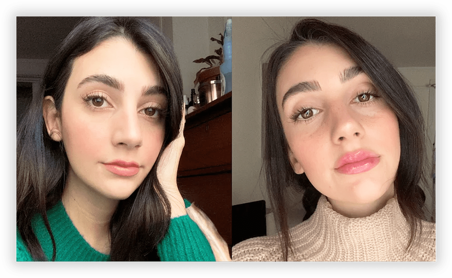 Non Surgical Facelift 2