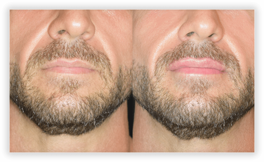 Lip Filler 4