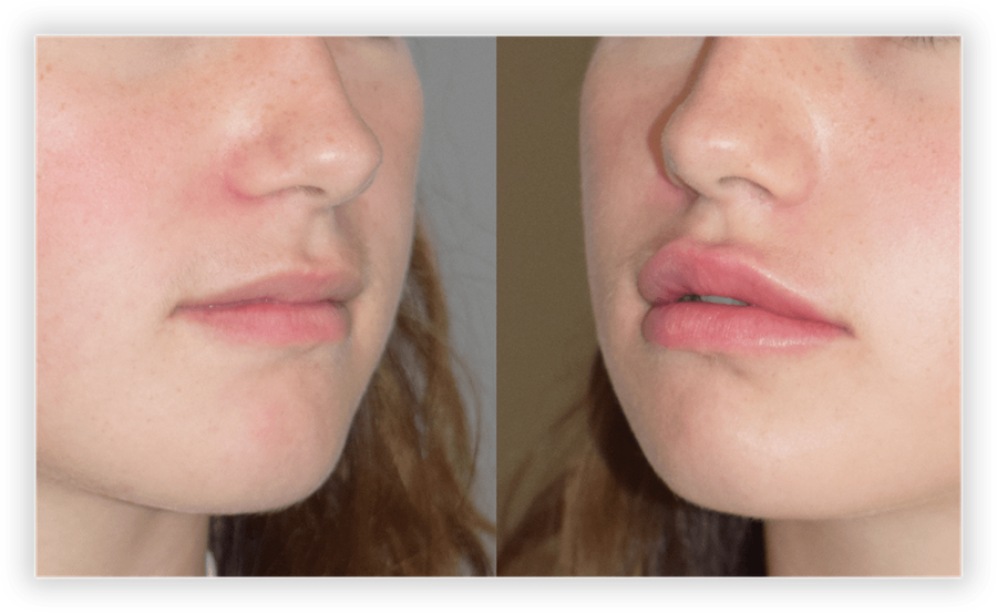 Lip Filler 3