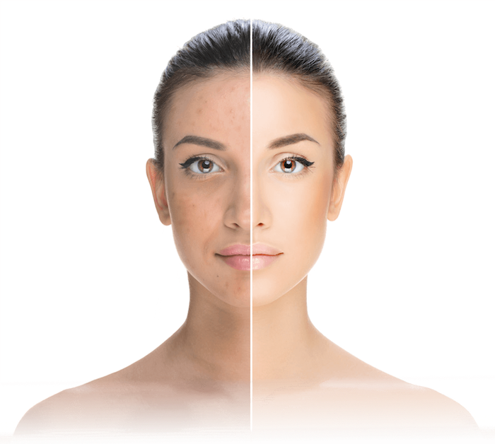 No Surgical Face lift - Mississauga Doctor