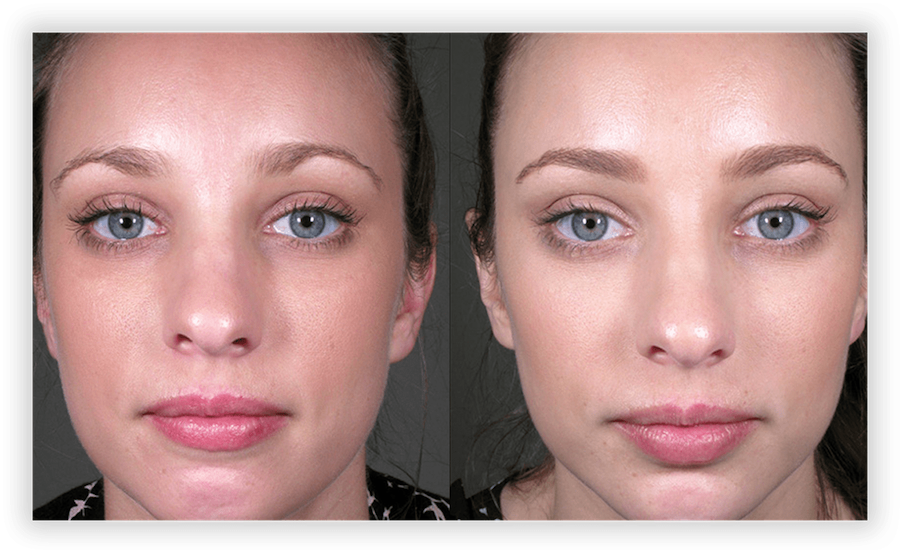 Non Surgical Facelift 1