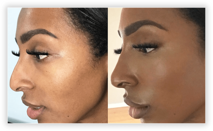 Nose Job 3