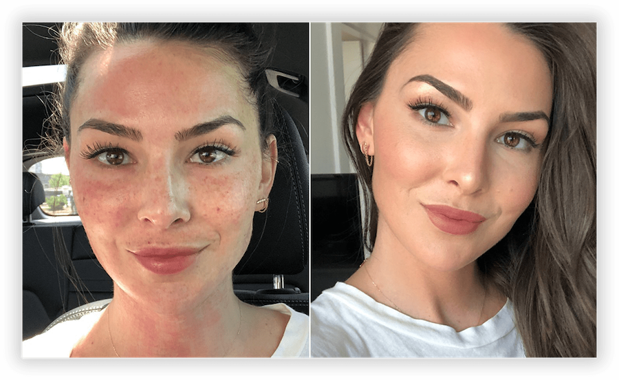 Vampire Facial 1
