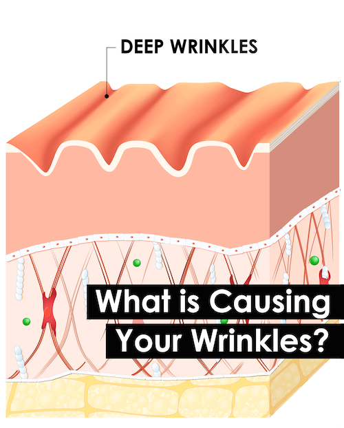 What Causes Your Wrinkles