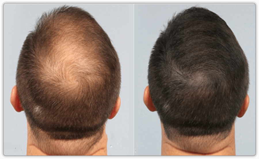 PRP Hair resoration Before and After 2