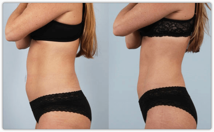 Before and After