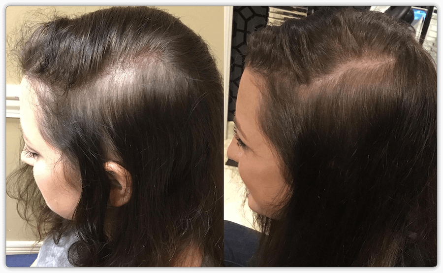 PRP Hair resoration Before and After