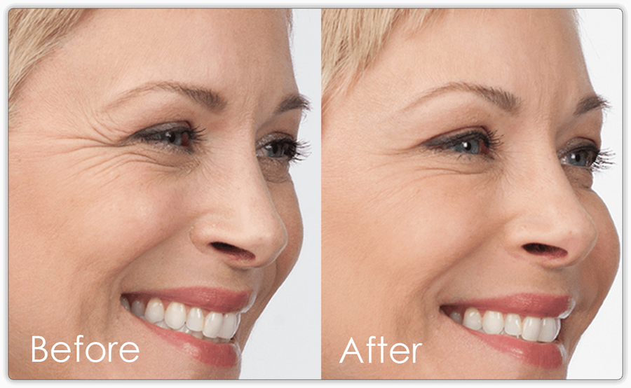Before After 3