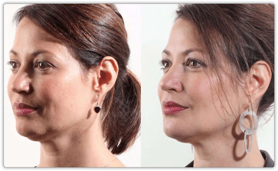 Before After 3