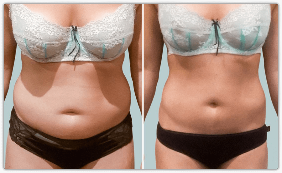 Before After 3