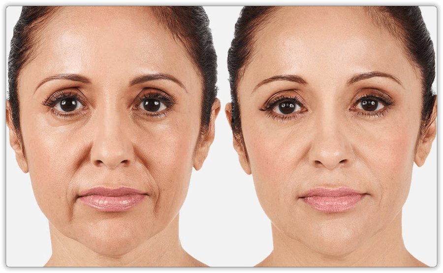 Before After 4