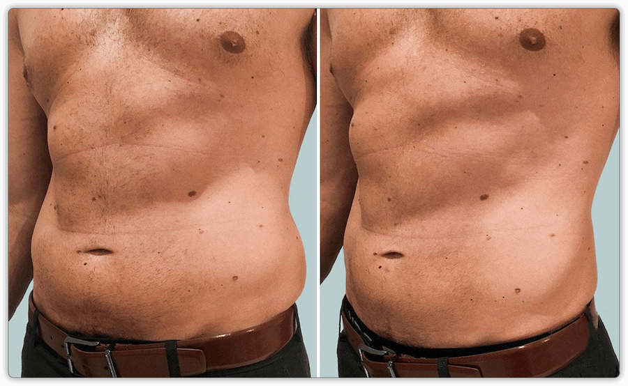 Before After 4