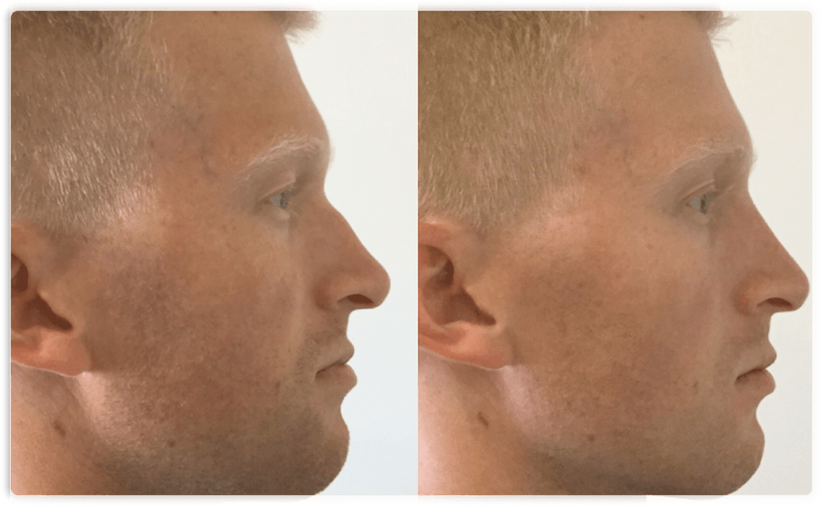 Before After 1