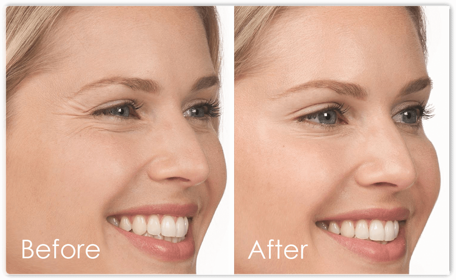 Before After 4